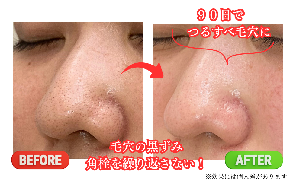 90日でつるすべ毛穴に
毛穴の黒ずみ角栓を繰り返さない!
Before
after